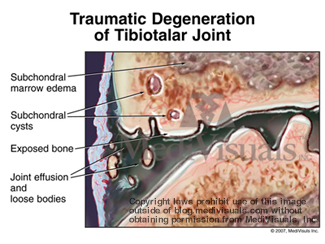 Ac Joint Resection