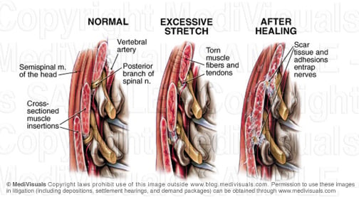 Muscle Spine