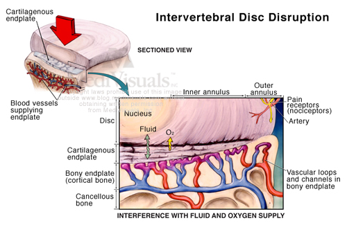 disc-disruption