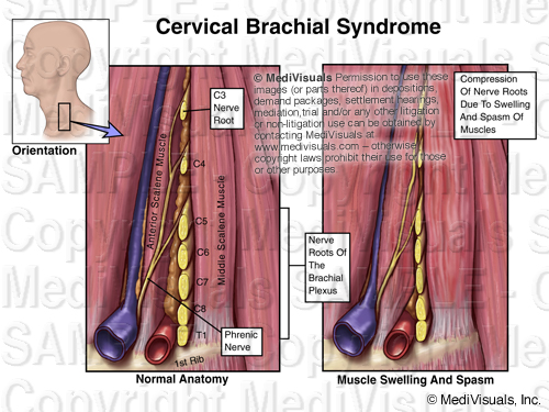Brachial Plexus 205299 02XB