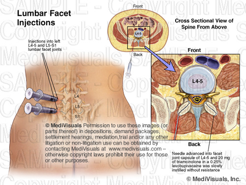 lumbar facet pain