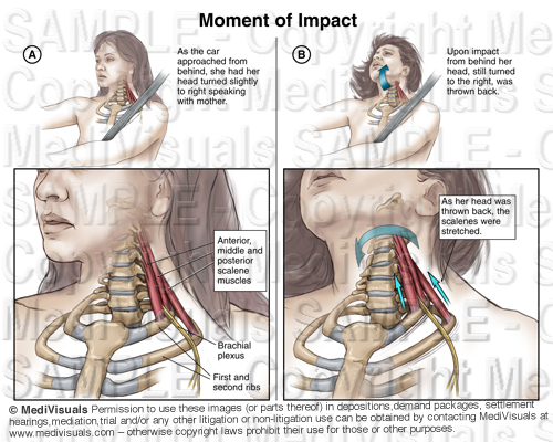 Understanding the Brachial Plexus Injury: Part 1