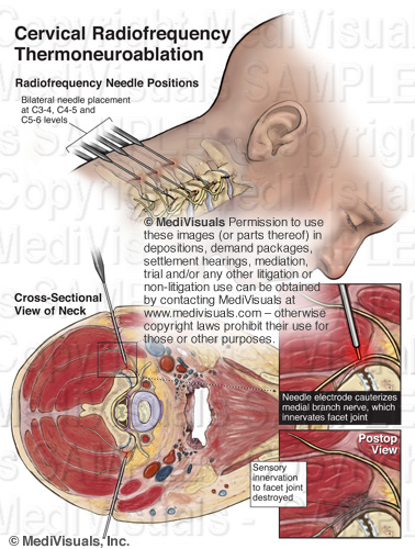 Ablation of Nerve