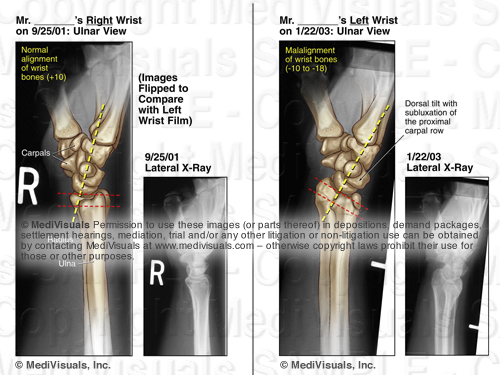 Alignment Misalignment of Wrist