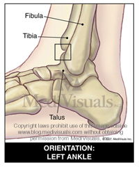 arthritis-tibiotalar-joint