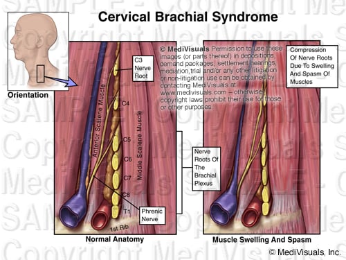 Brachial Plexus 205299 02XB