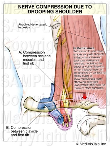 Brachial Plexus 399048 04Apart1