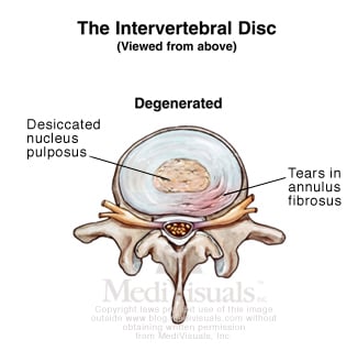 degenerated-disc