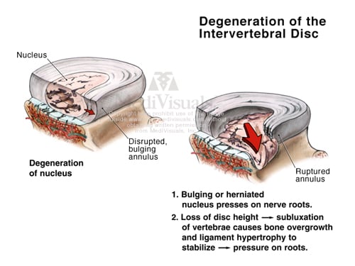 degeneration-of-disc