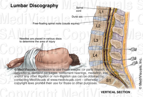 Lumbar Discography Exhibit
