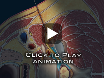 Epidural Injection Movie 300