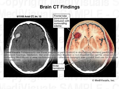 hematoma, ct scan, brain injury