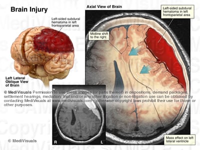 Hematoma, traumatic 