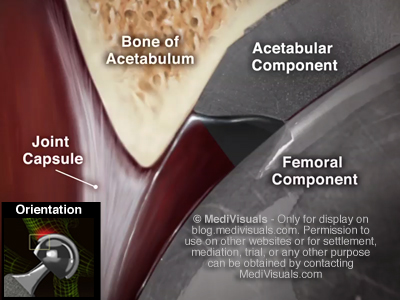 Hip Replacement Recall Anatomy