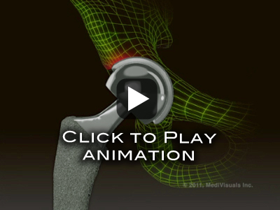 Hip Replacement Recall Animation