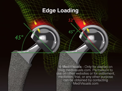 Hip Replacement Recall Edge Loading