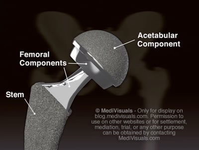 Hip Replacement Recall Implant Components