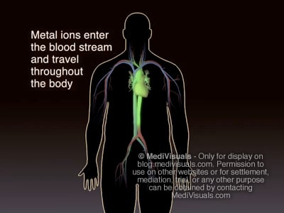 Hip Replacement Recall Metal Bloodstream