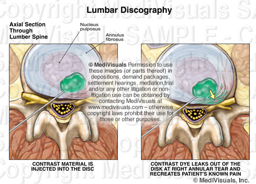 Lumbar Discography