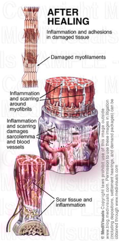 muscle-after-healing