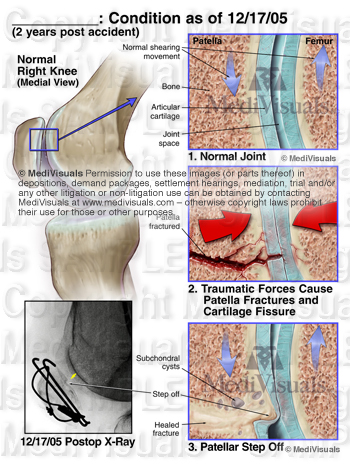 Patella Fracture Knee Joint