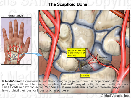 Scaphoid Avascular Necrosis