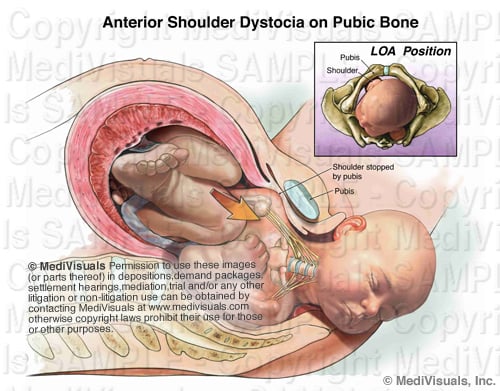Shoulder Dystocia