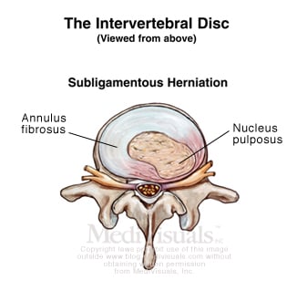 subligamentous-herniation