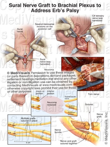 Sural Nerve Graft
