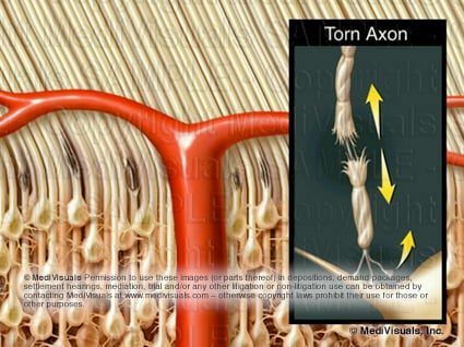 tornAXON