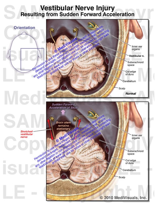Vestibular Nerve Injury 500