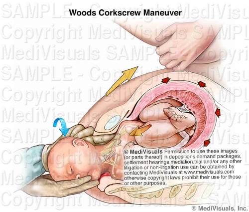 Woods Screw Maneuver 604058 03X