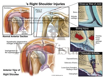 arthritis-AC-joint-shoulder