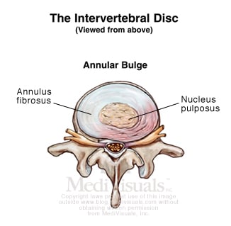 annular-disc-bulge