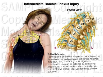 Brachial Plexus R14893 05X