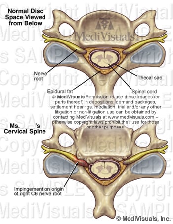 cervical osteophytes