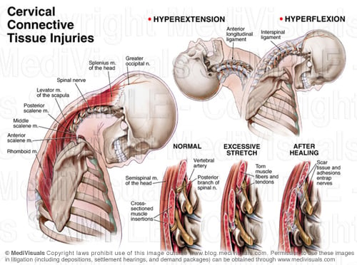 Cervical spine: Anatomy, ligaments, nerves and injury