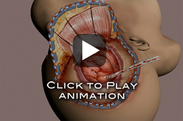 craniotomy animation traumatic brain injury