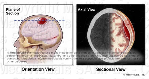 cross-section plane of brain hematoma