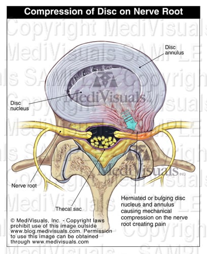 Discogenic Pain - My Client Has Pain but No Disc Herniation