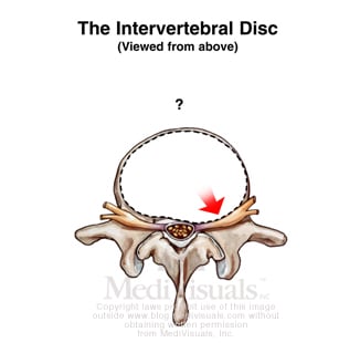 impinge-disc-injury