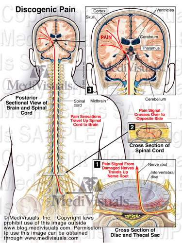 Discogenic Pain