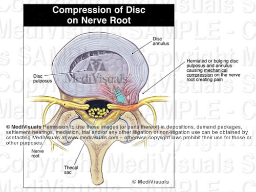 DiscPainBlogA 2