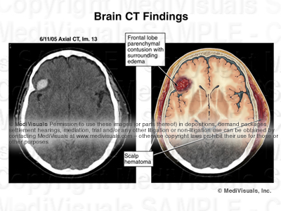hematoma, ct scan, brain injury