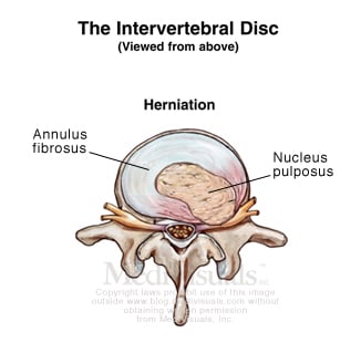 Disc Herniation and Other Disc Injuries