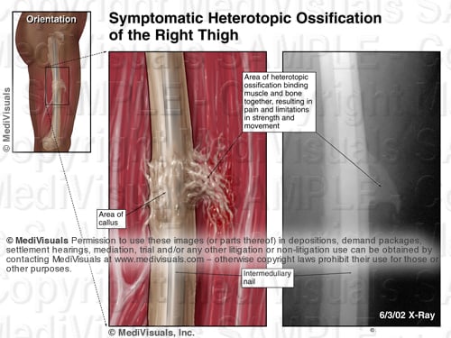 Heterotopic Ossification Thigh Fracture