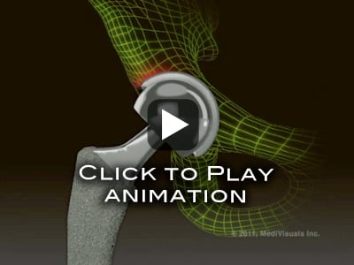 Hip Replacement Recall Animation