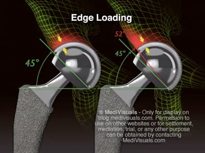 Hip Replacement Recall Edge Loading