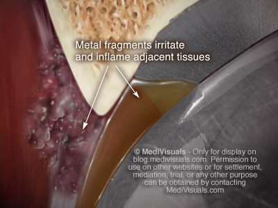 Hip Replacement Recall Metal Irritation Pseudotumor
