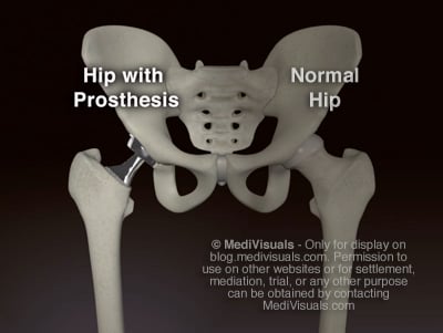 Hip Replacement Recall Pelvic Anatomy